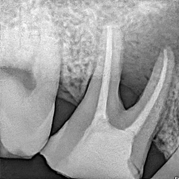 Root canal treatment