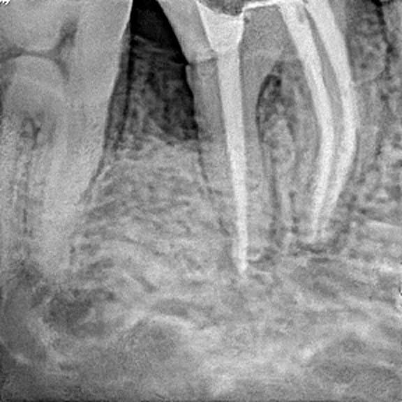 Root canal treatment