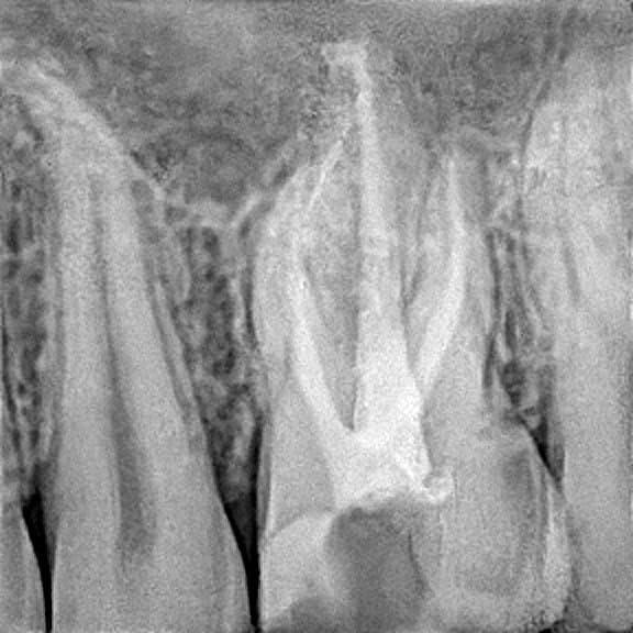 Root canal treatment