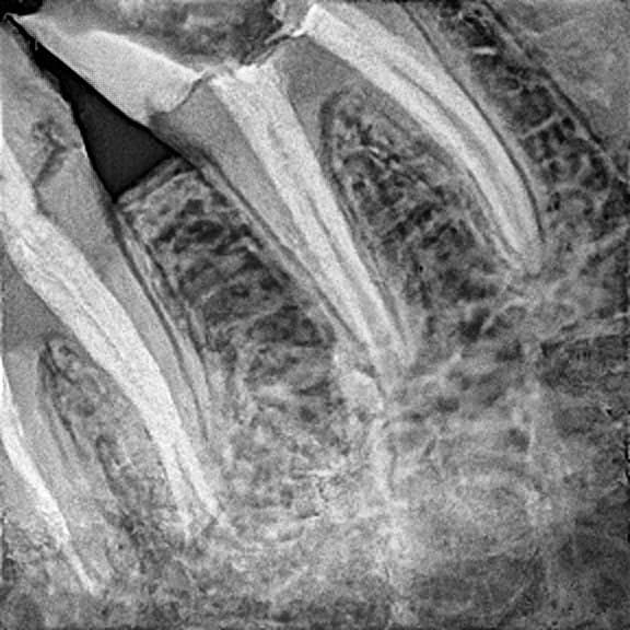 Root canal treatment