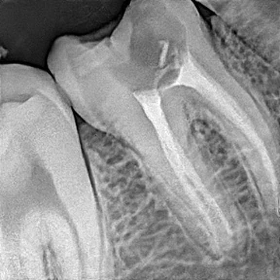 Root canal treatment