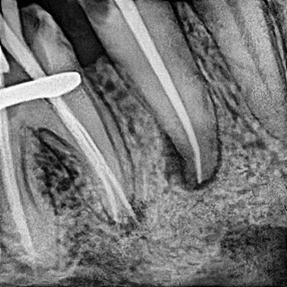 Root canal treatment