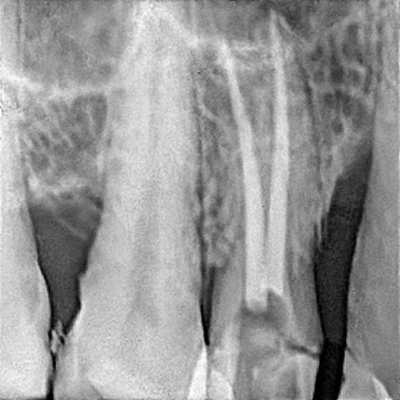 Root canal treatment