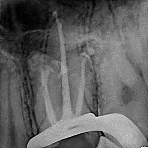 Root canal treatment