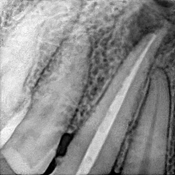 Root canal treatment