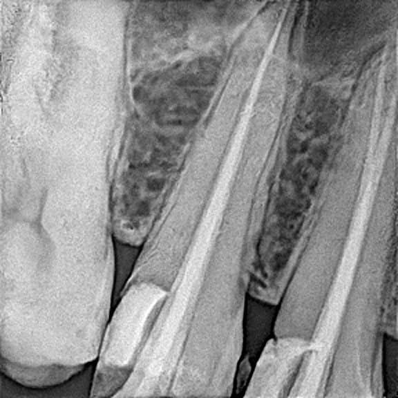 Root canal treatment
