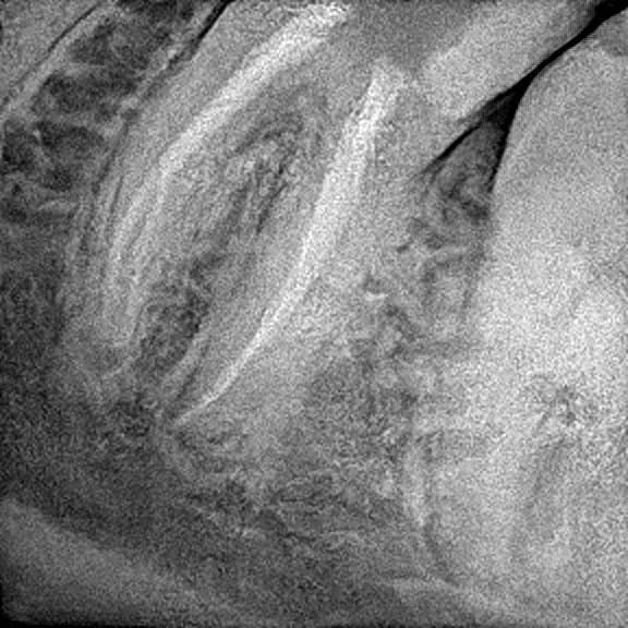 Root canal treatment