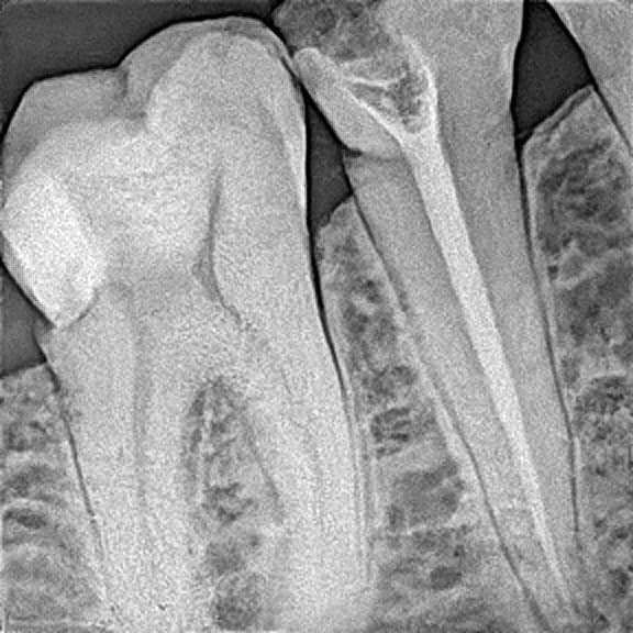 Root canal treatment