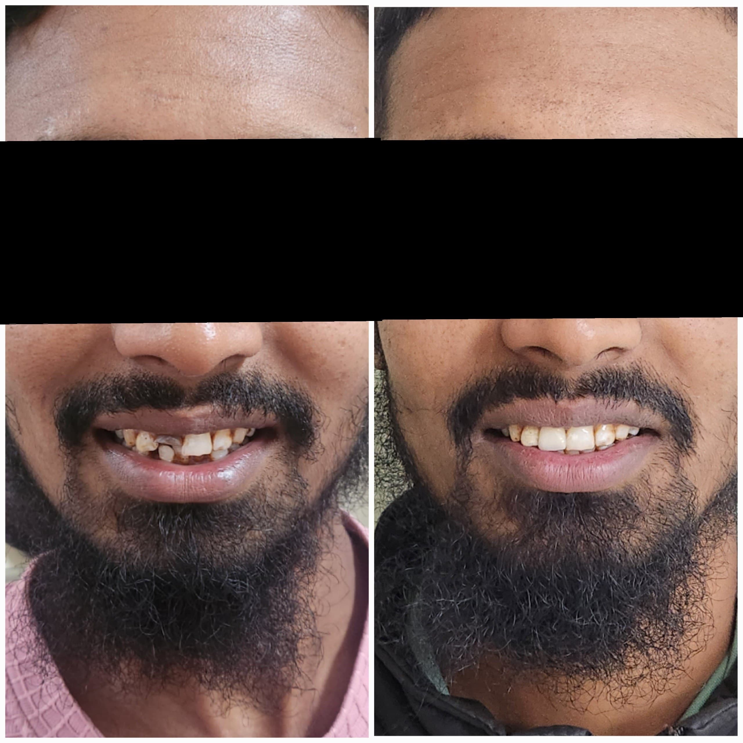 Smile makeover