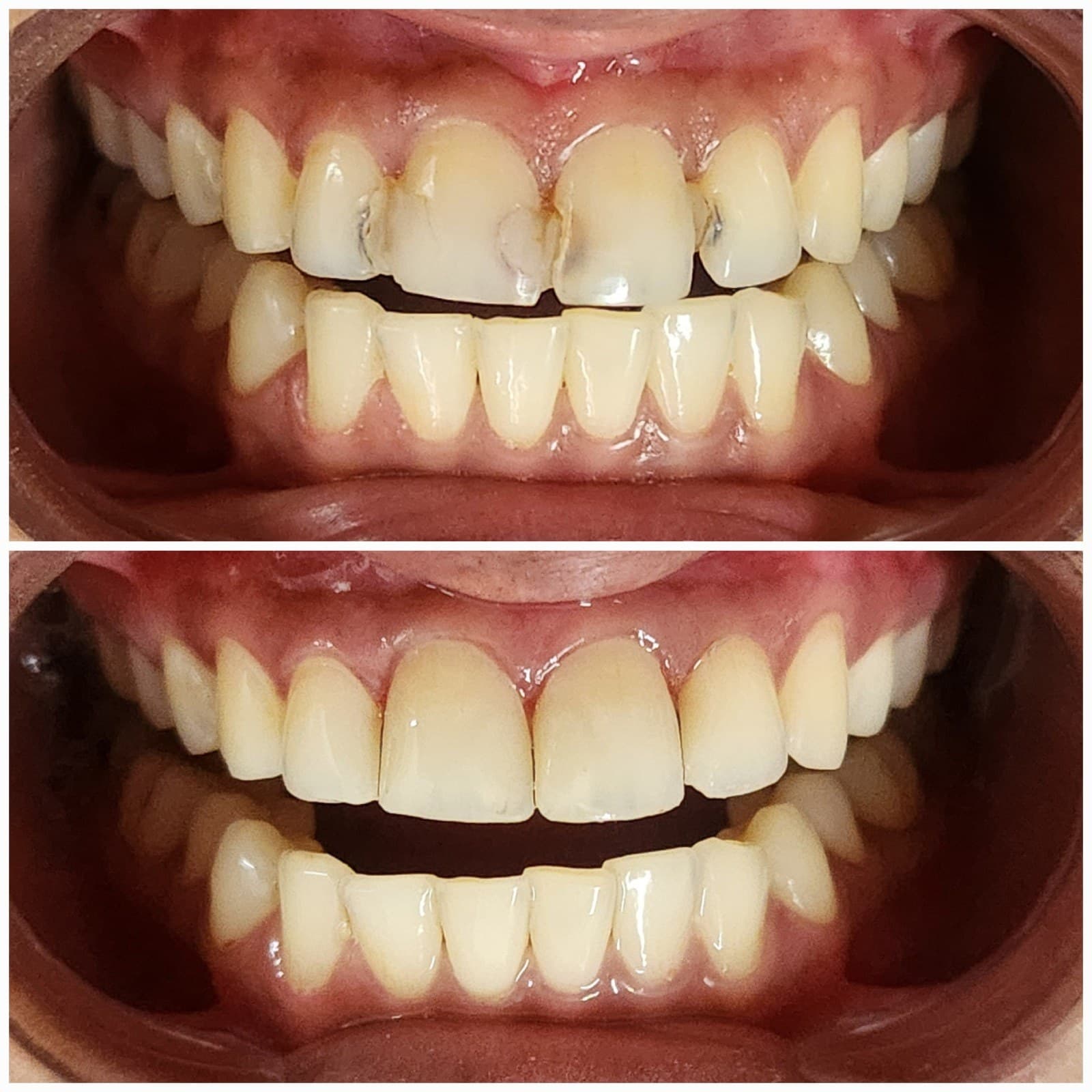 Smile makeover