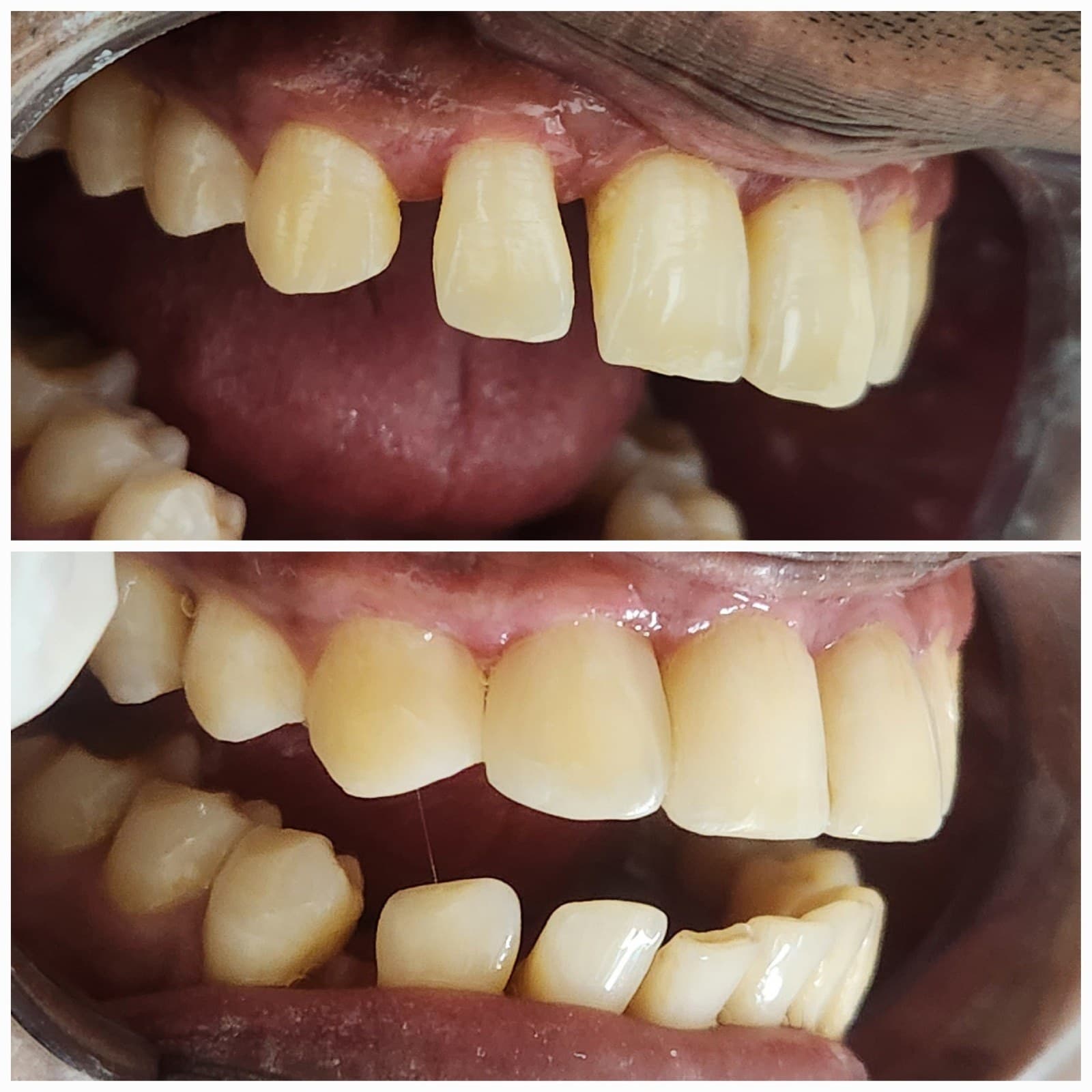 Smile makeover