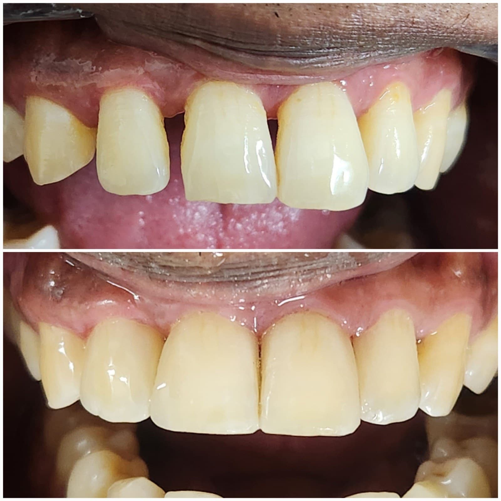 Smile makeover