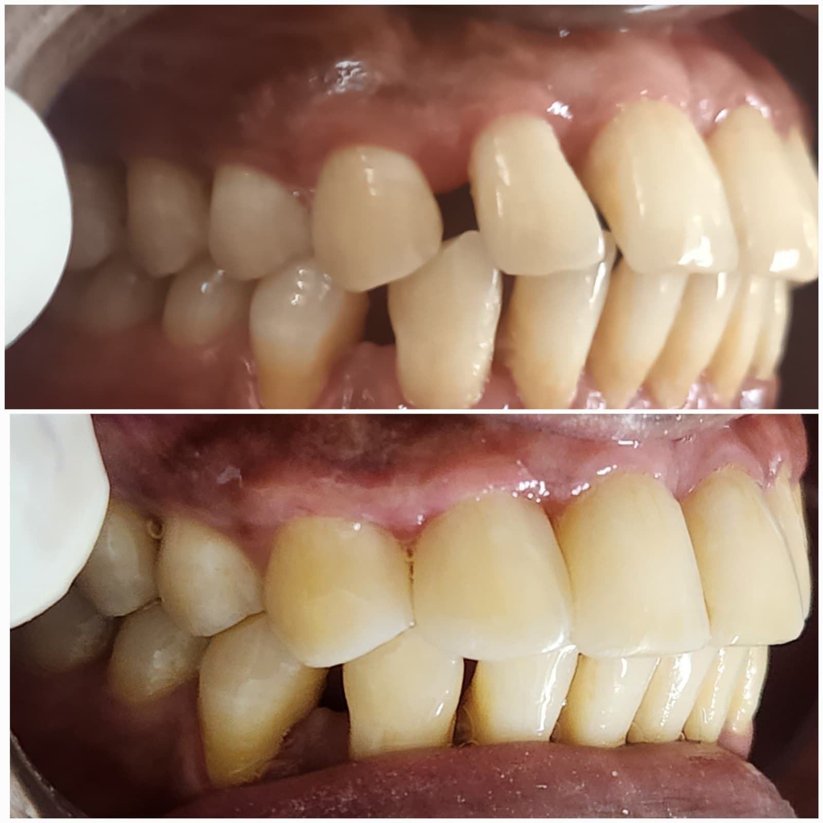 Smile makeover