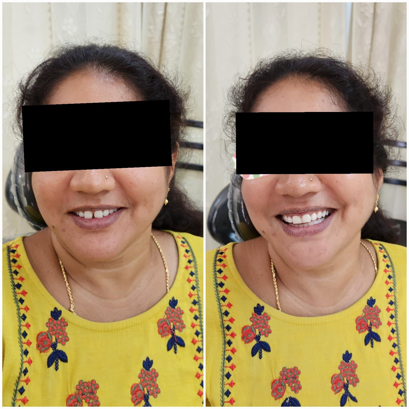 Smile makeover