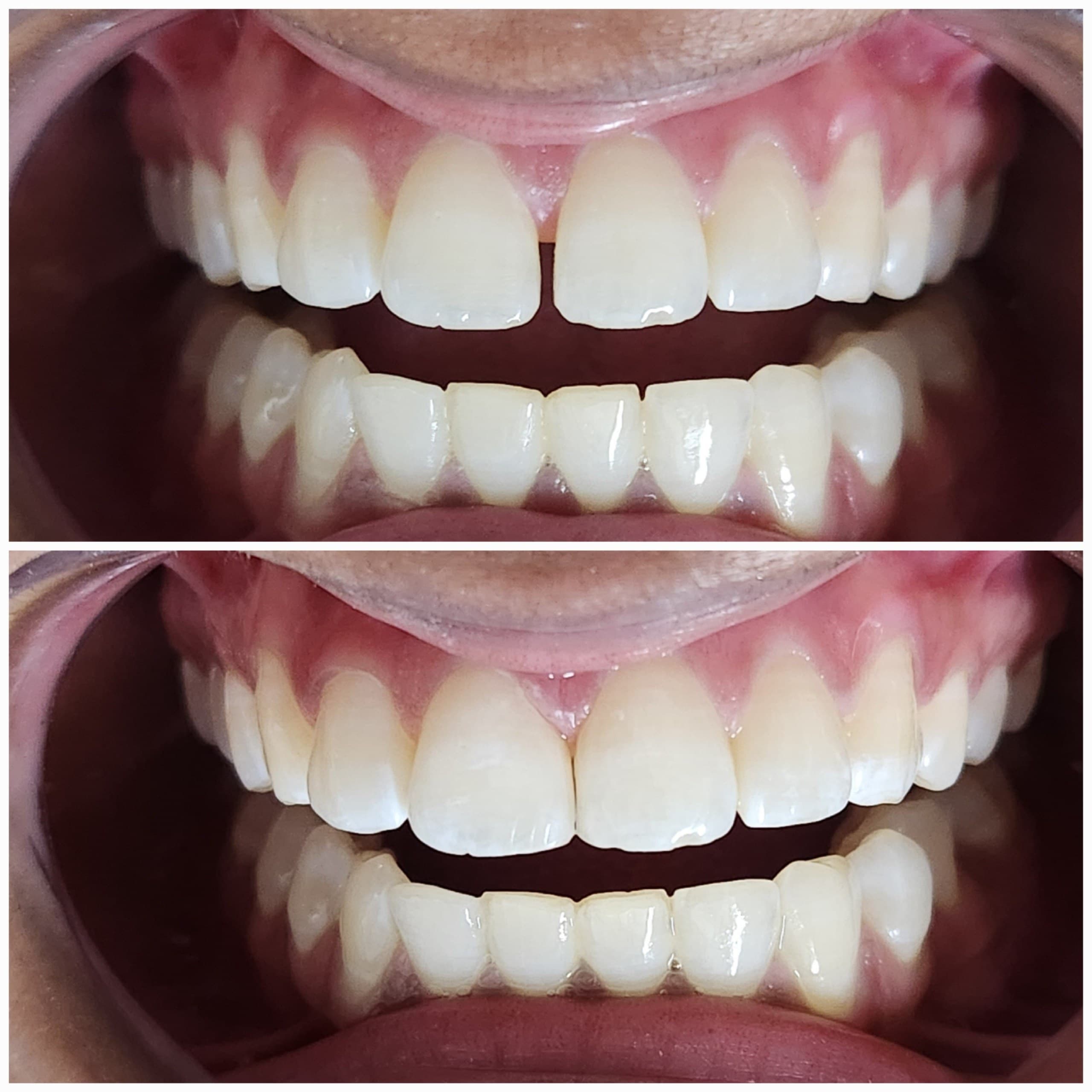Smile makeover