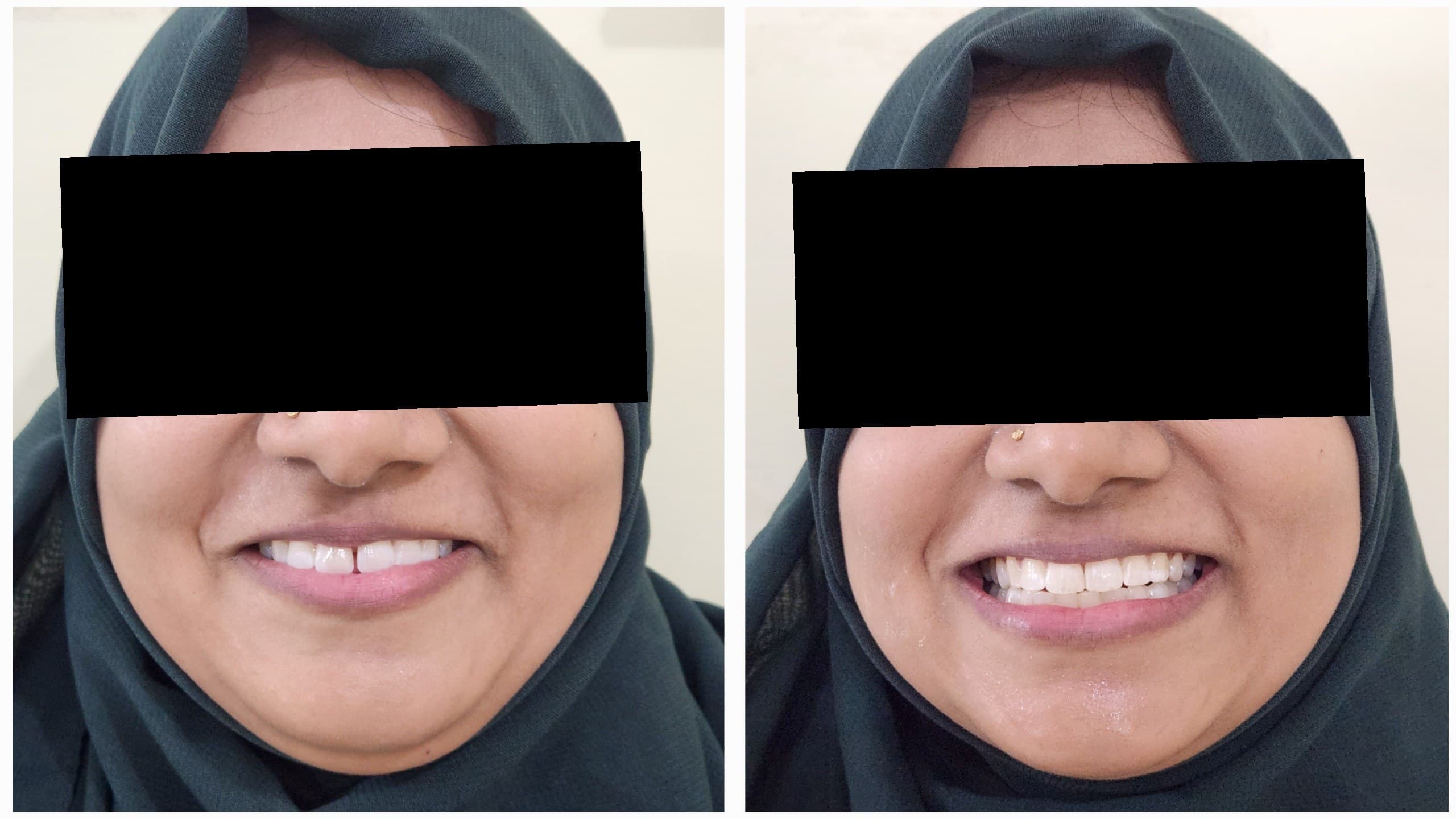 Smile makeover