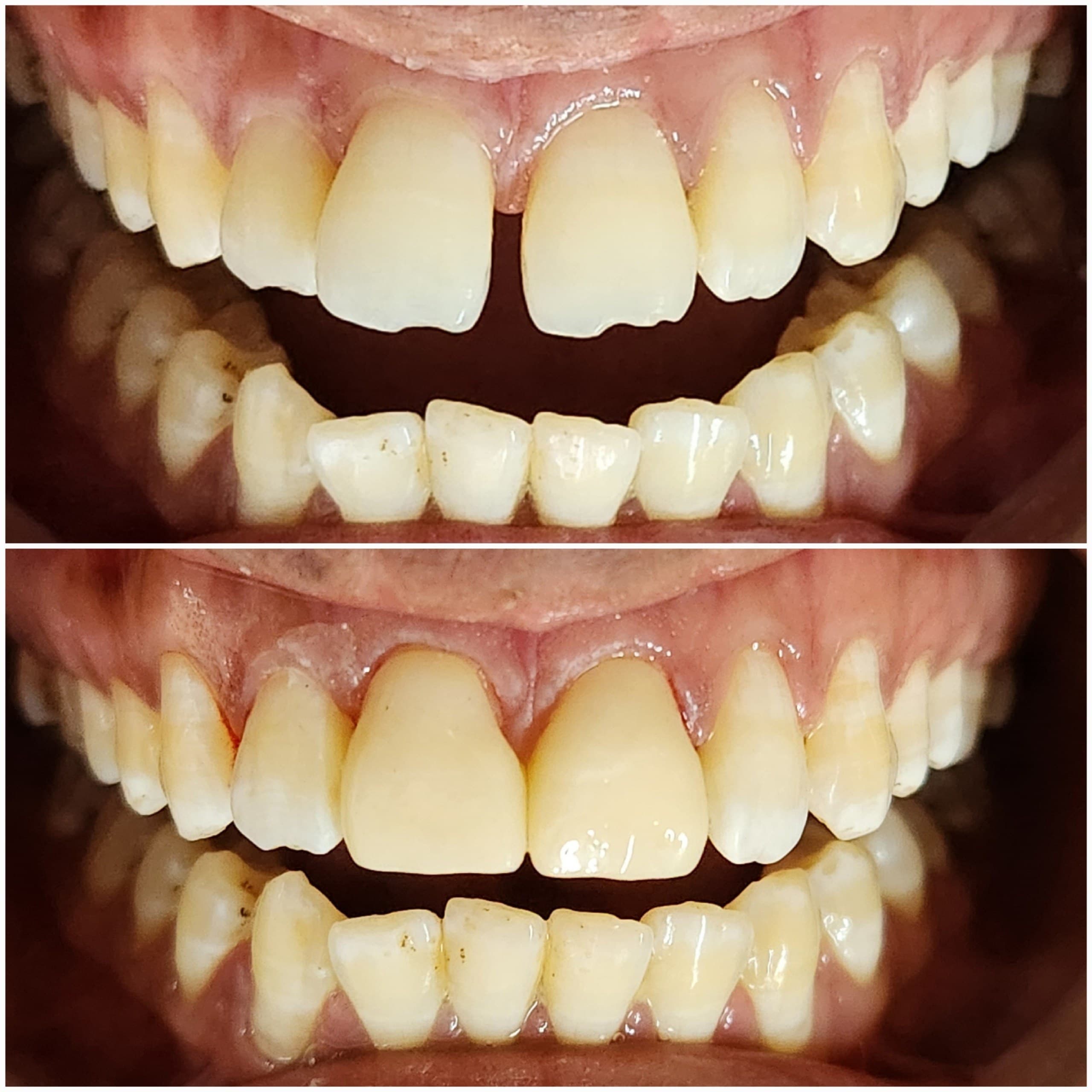 Smile makeover