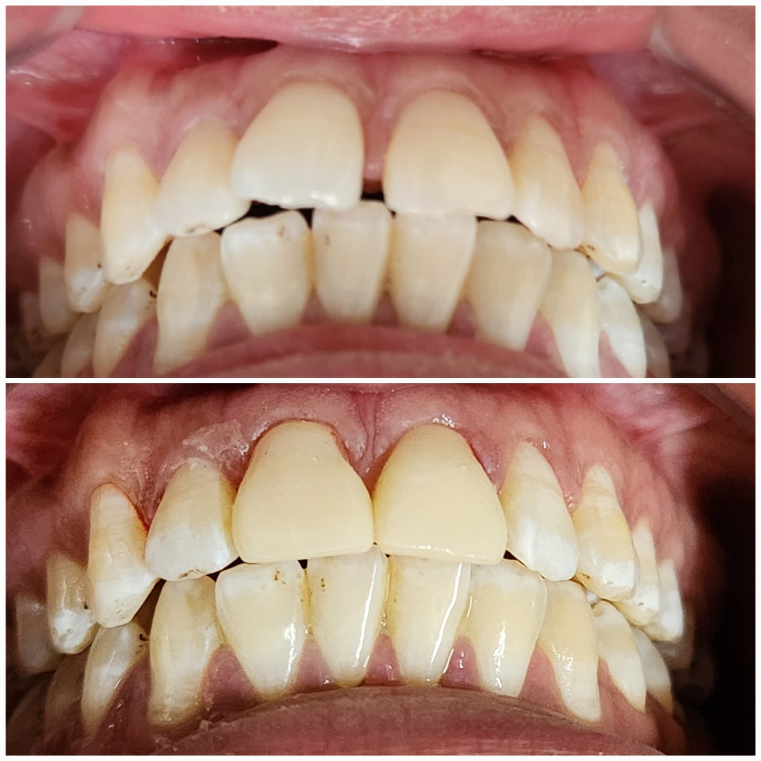 Smile makeover