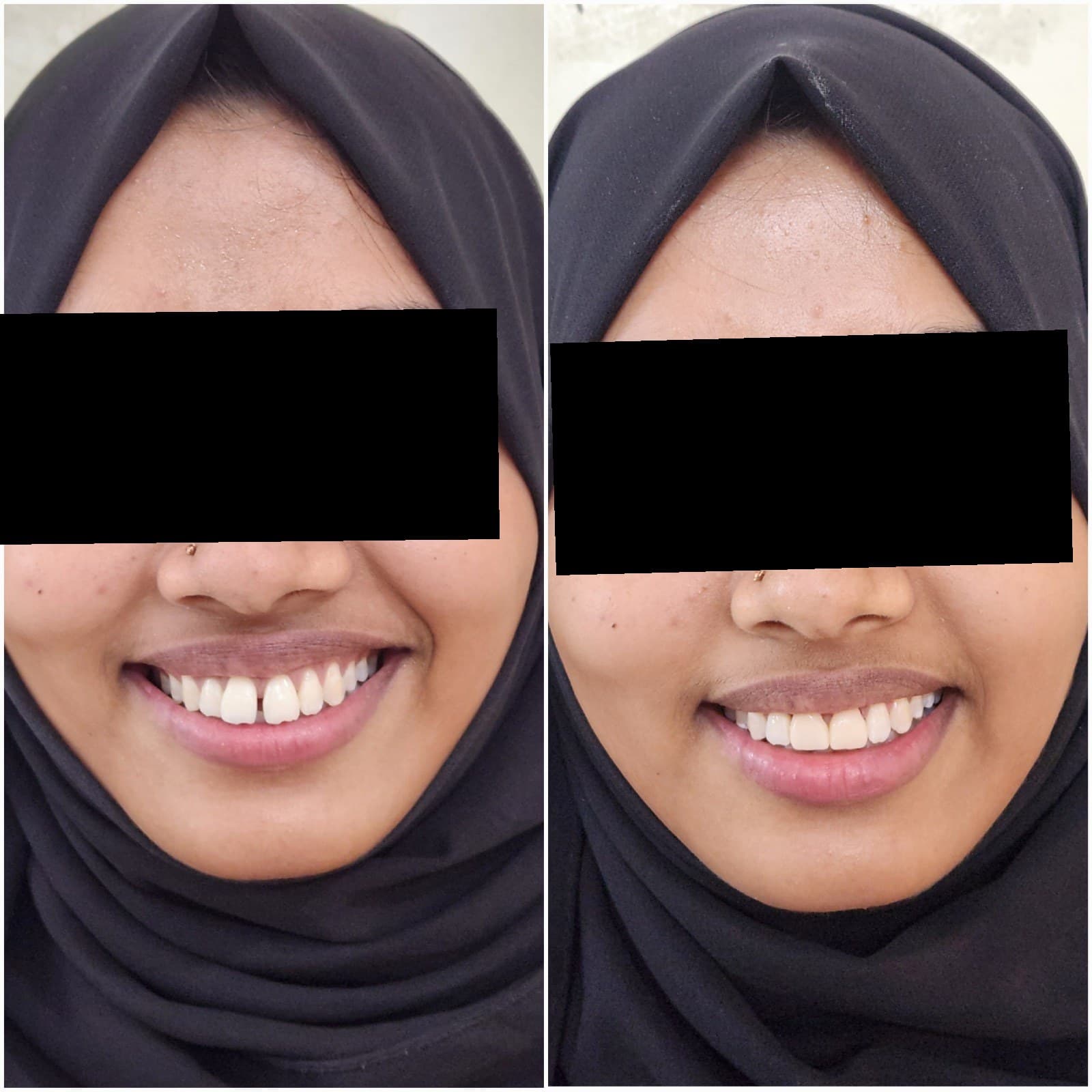 Smile makeover