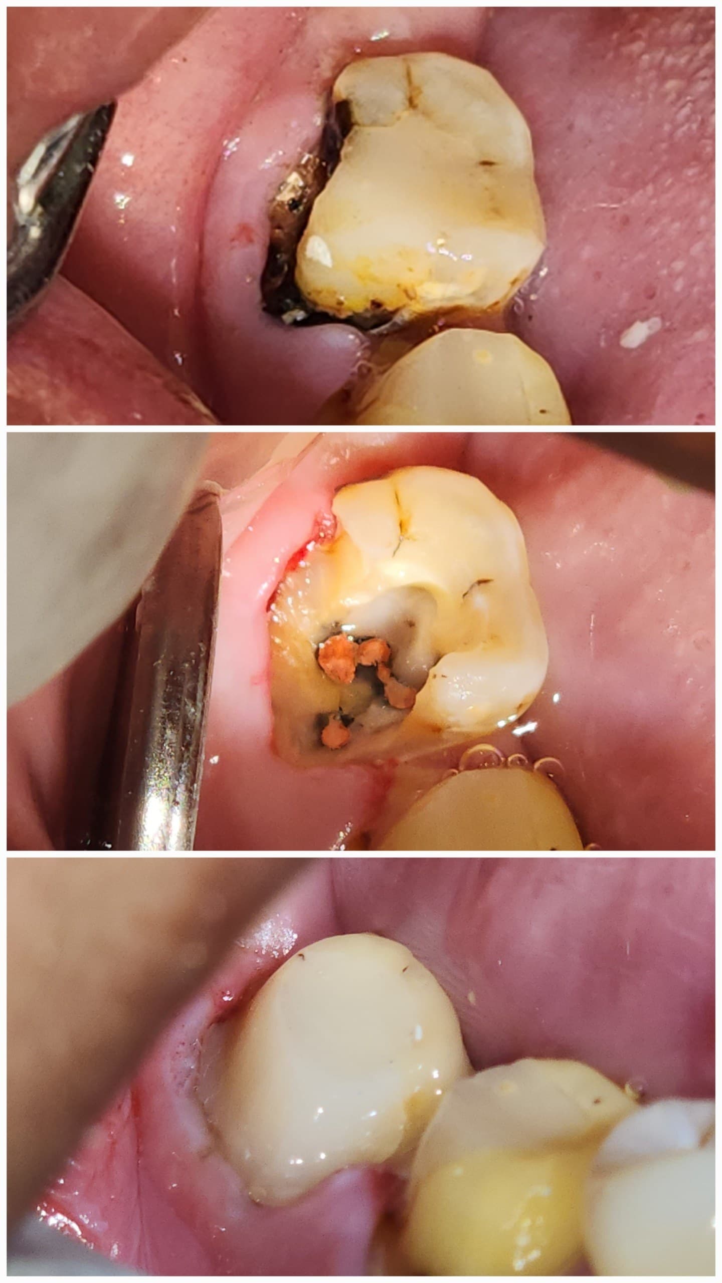Tooth replacement
