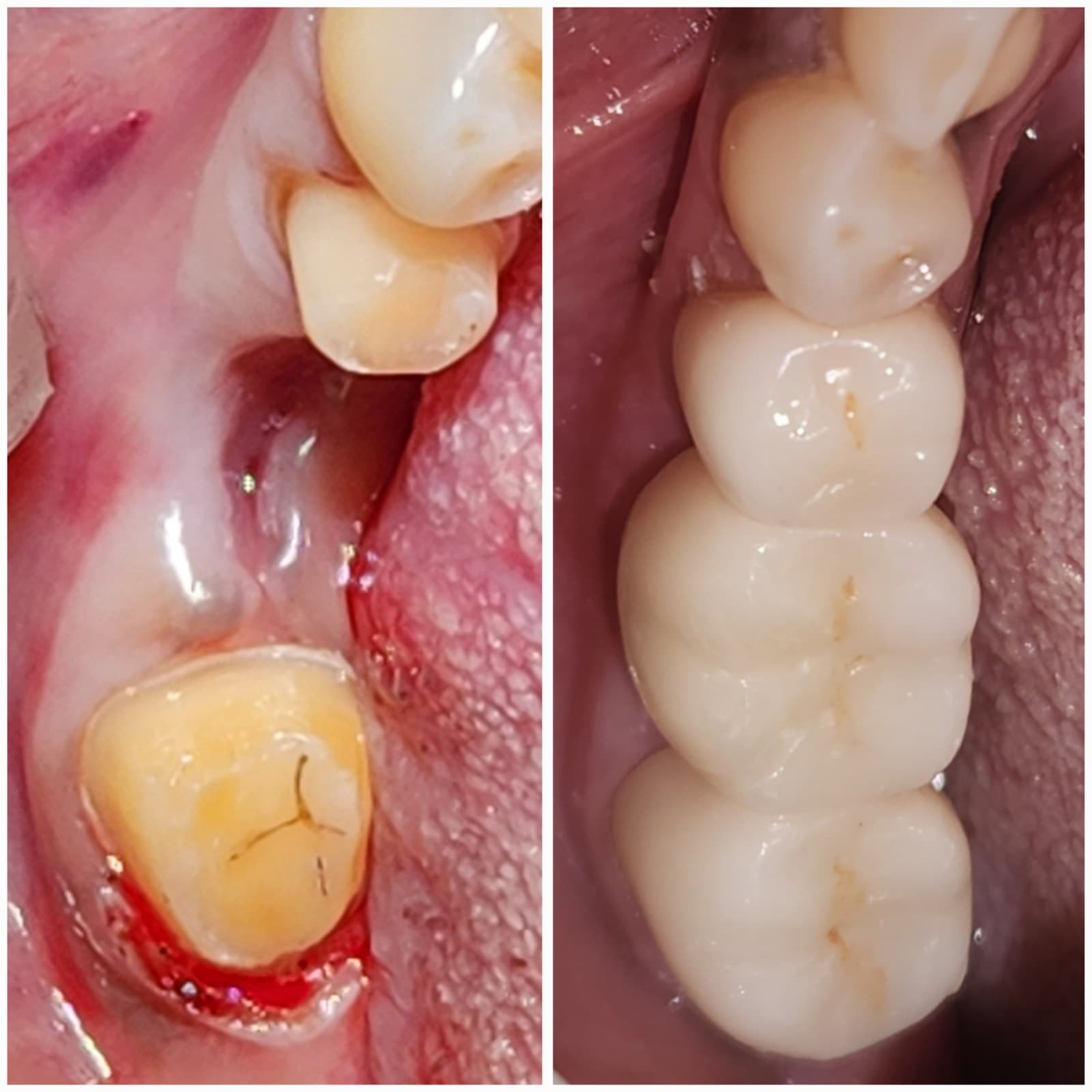 Tooth replacement