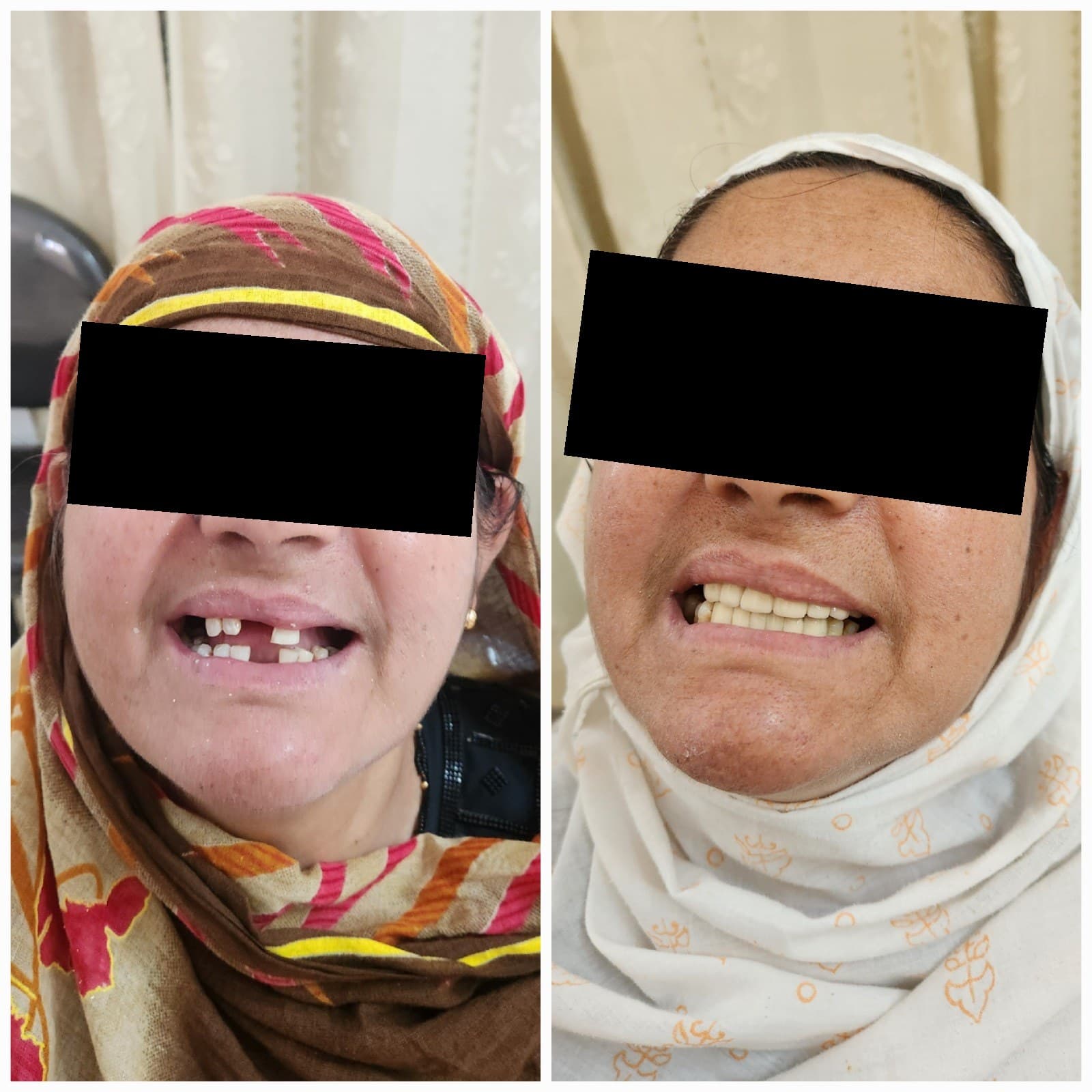 Tooth replacement