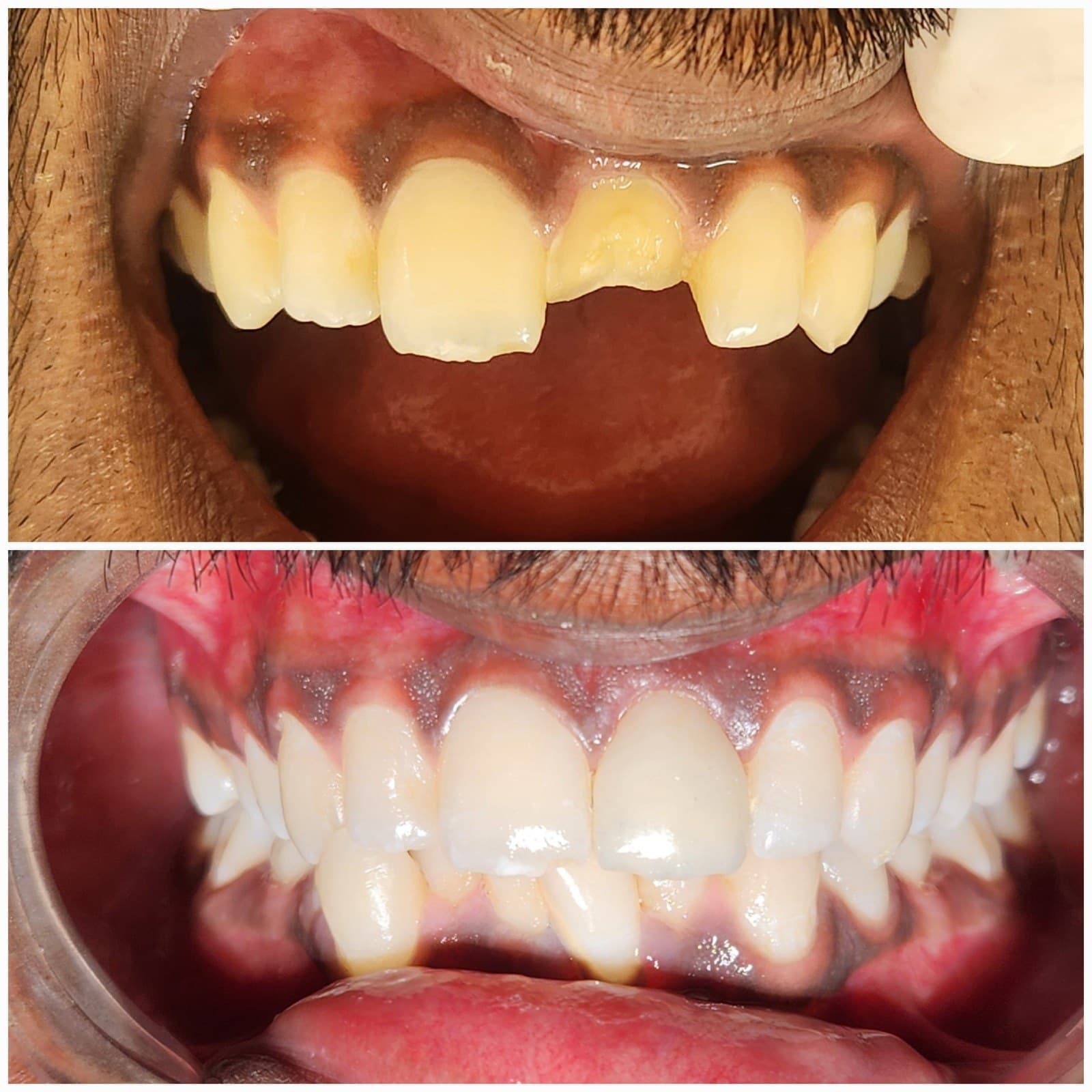 Tooth replacement
