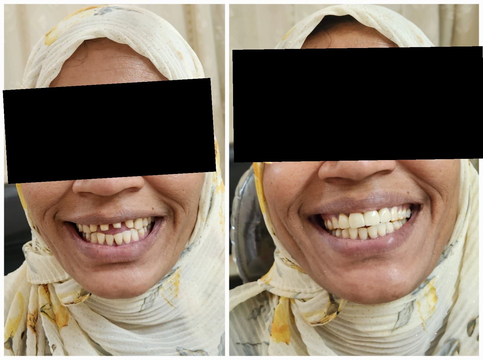 Tooth replacement