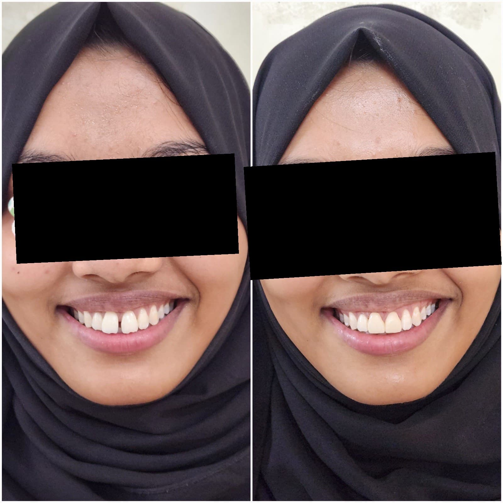 Tooth replacement
