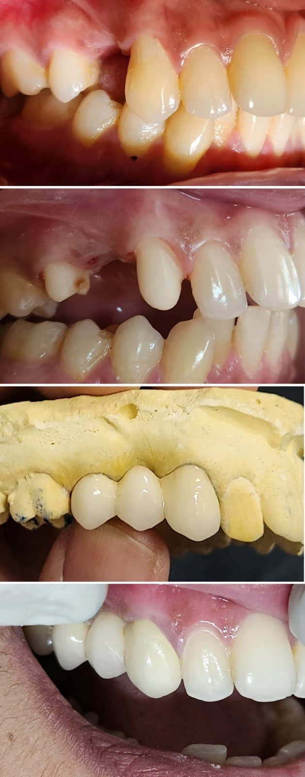 Tooth replacement