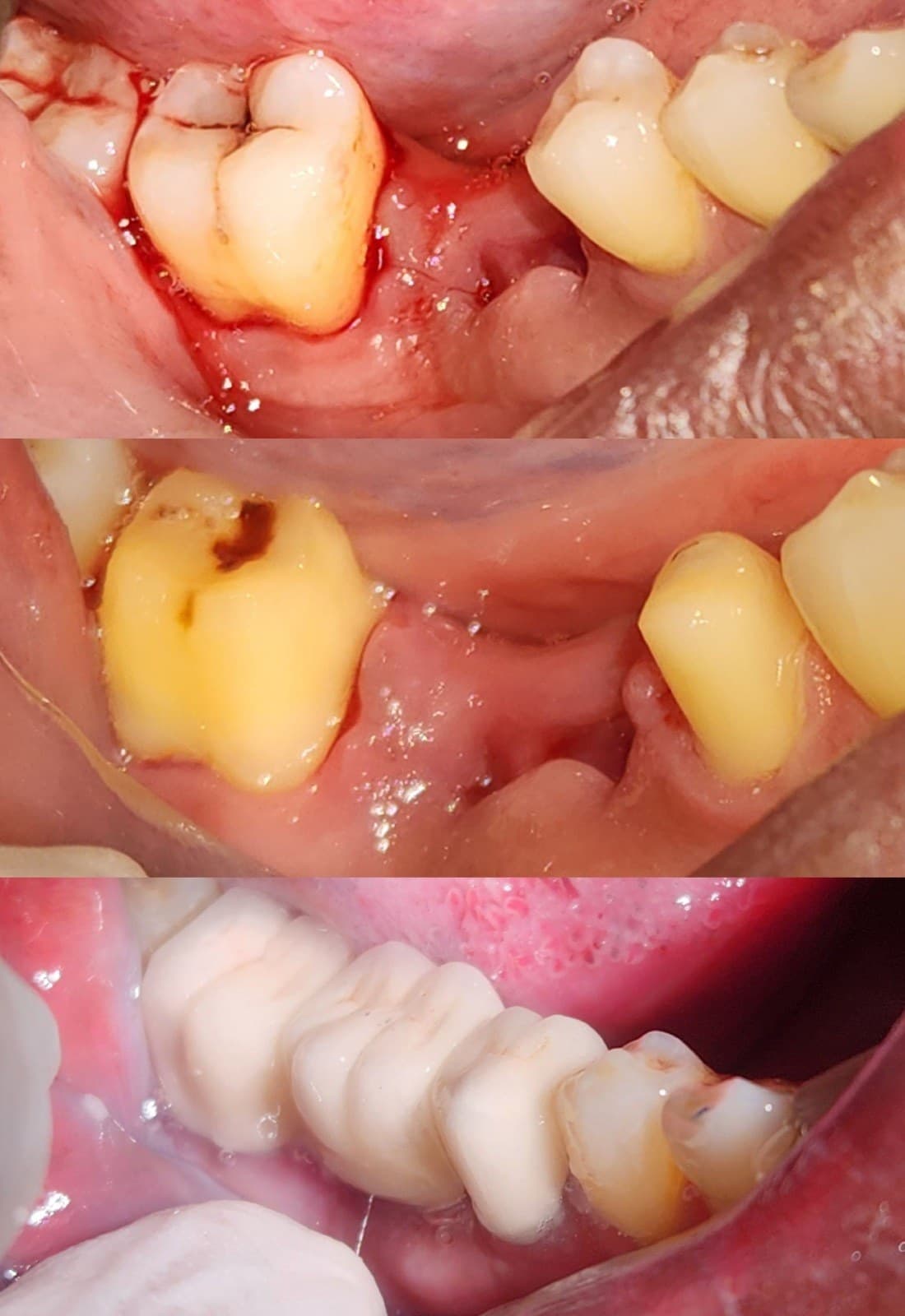 Tooth replacement
