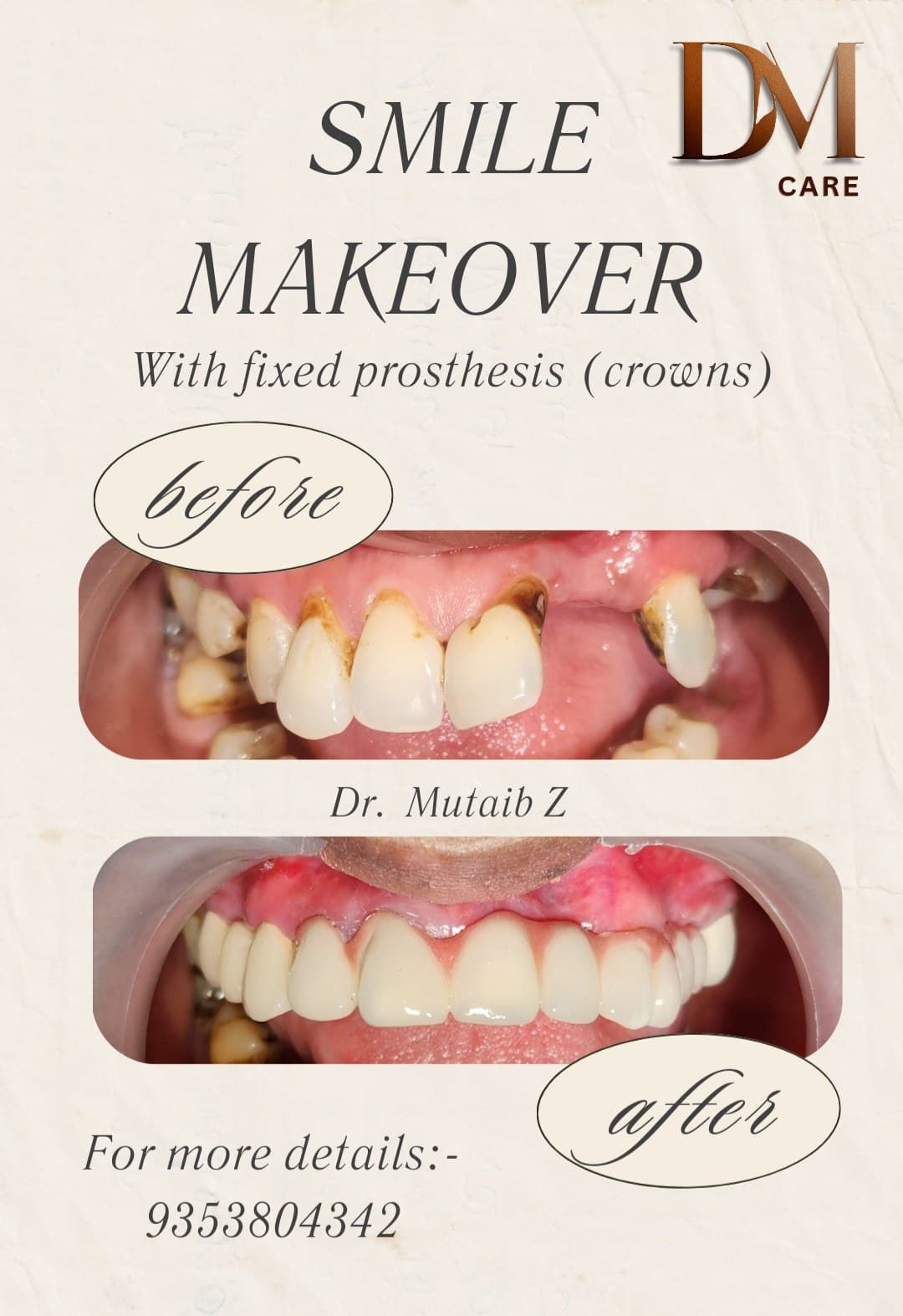 Tooth replacement