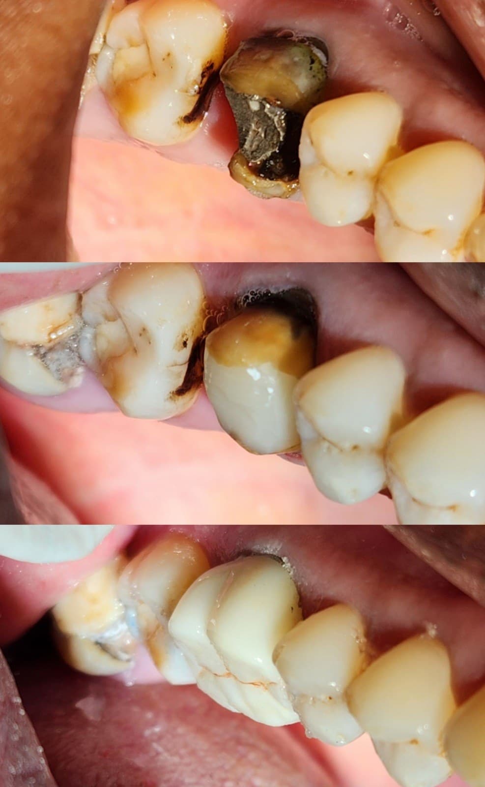 Tooth replacement
