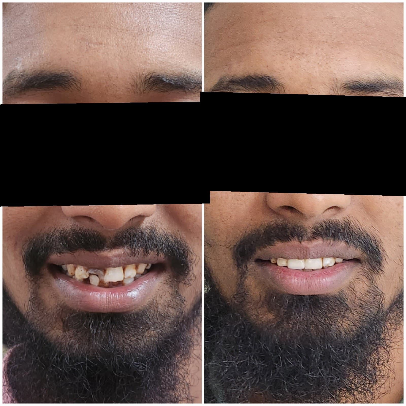 Tooth replacement
