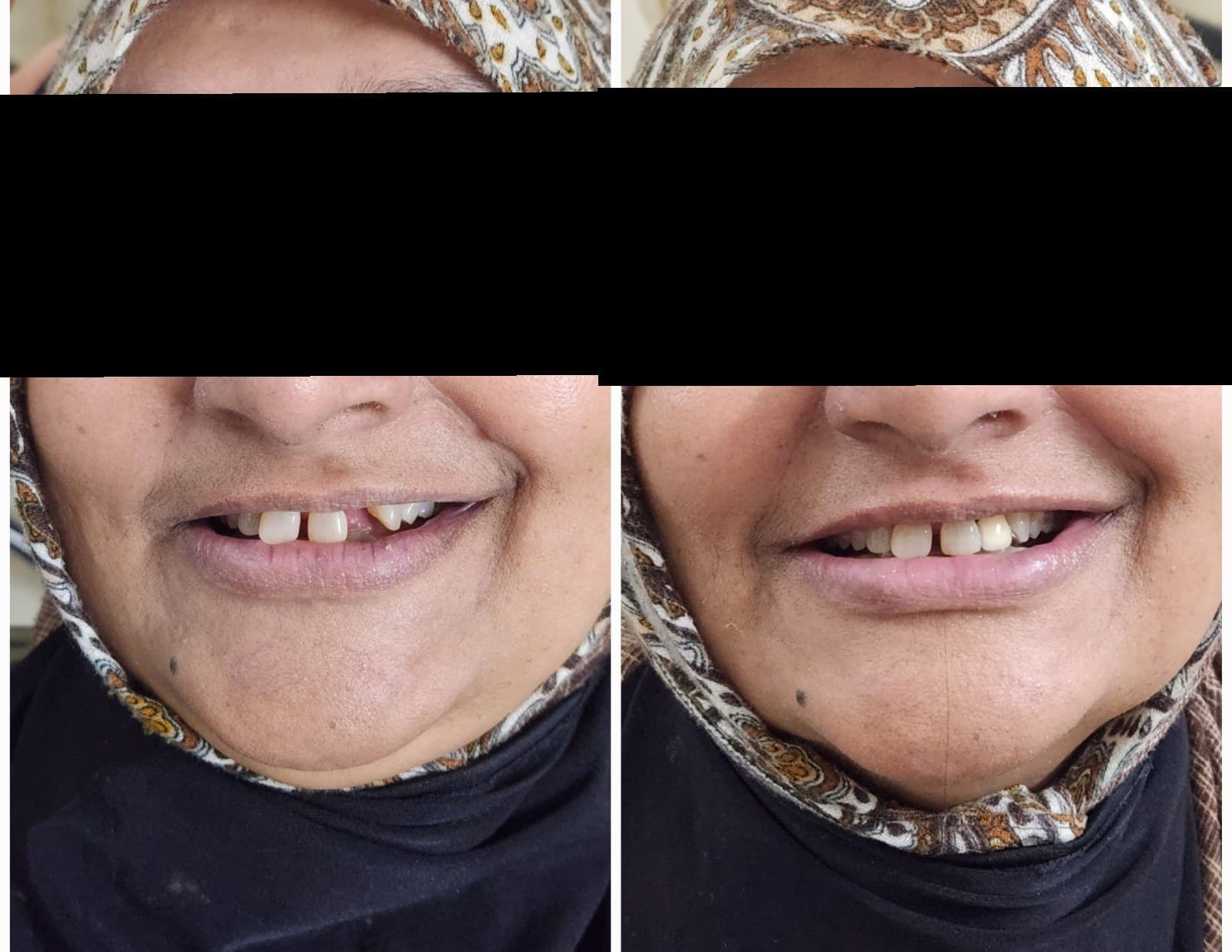Tooth replacement