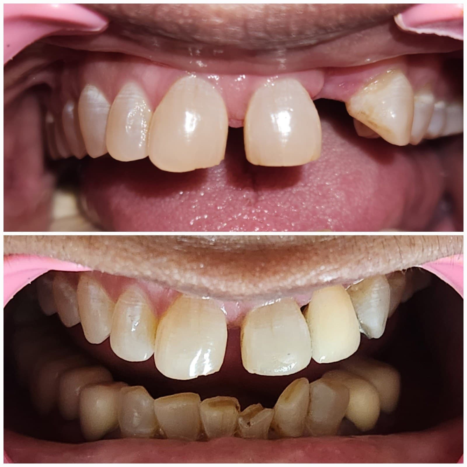 Tooth replacement