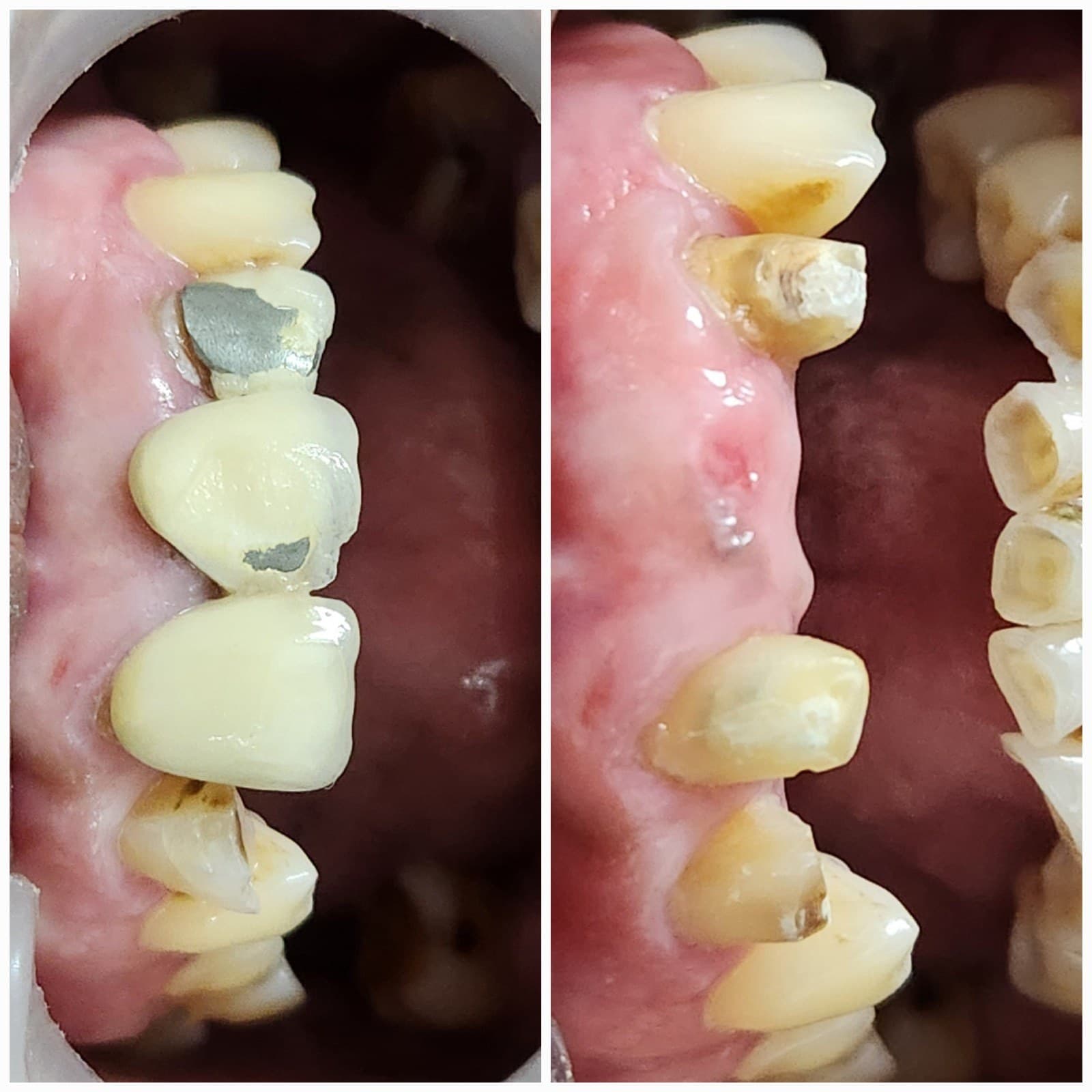 Tooth replacement