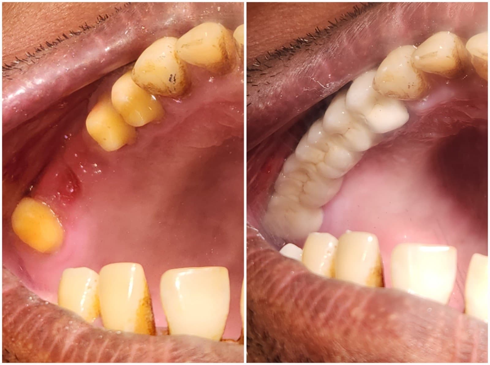Tooth replacement