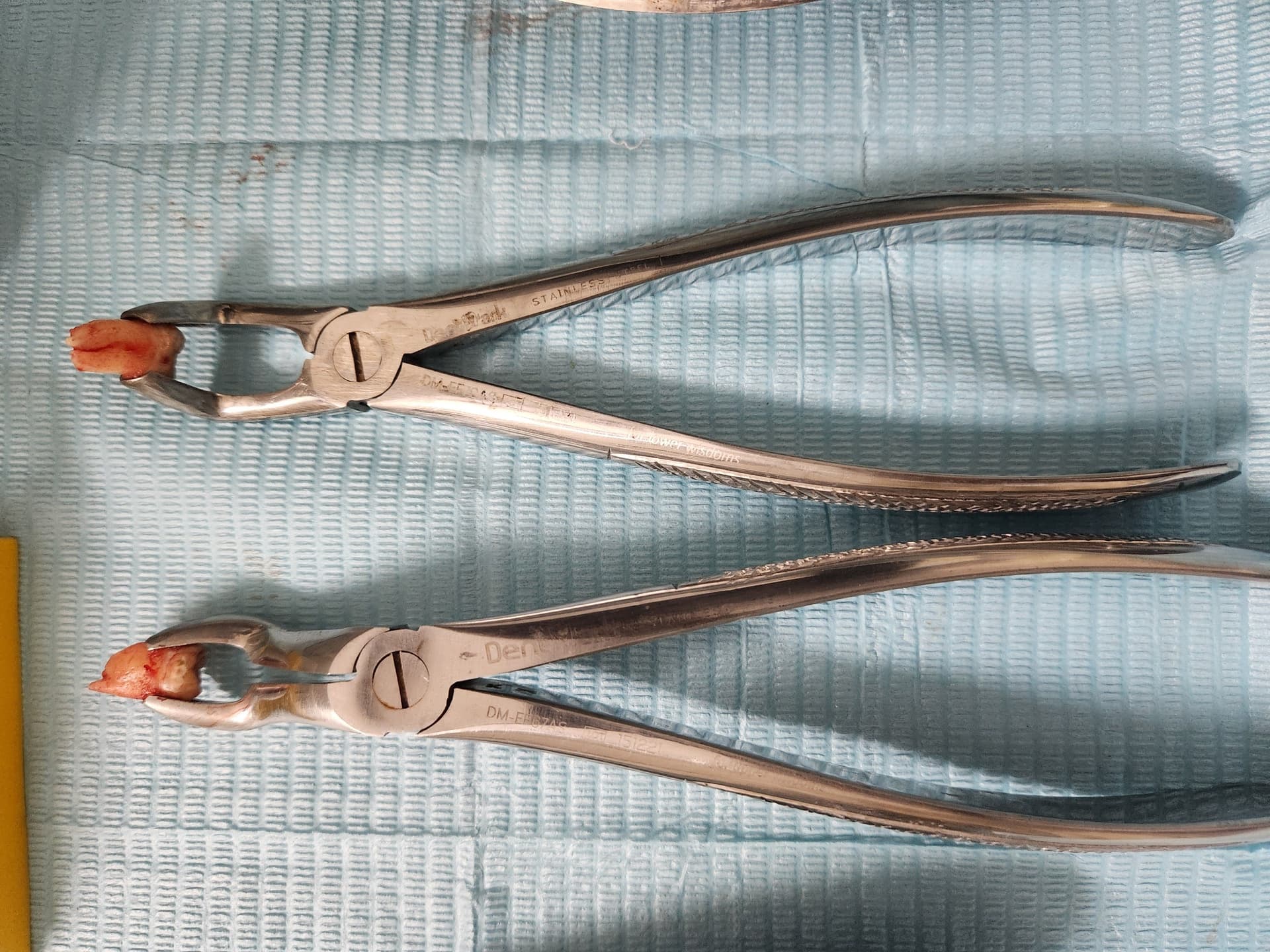 Wisdom tooth removal
