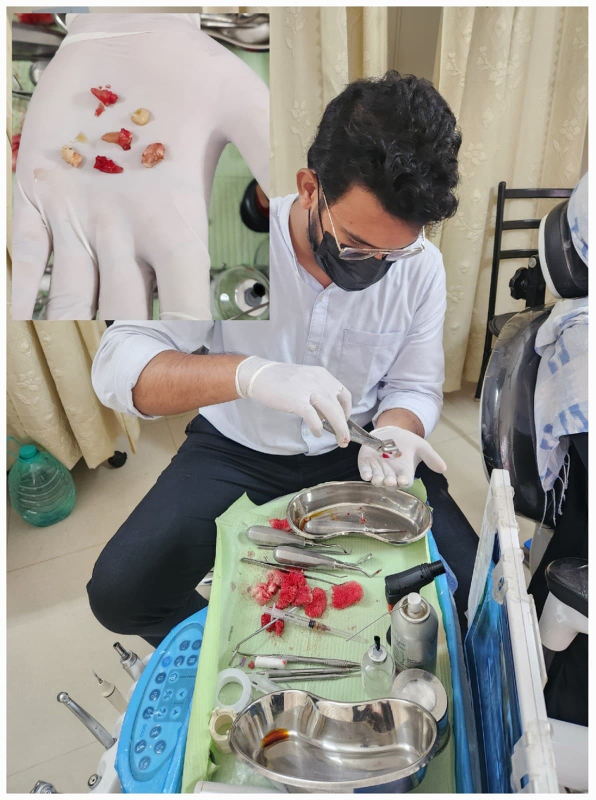 Wisdom tooth removal
