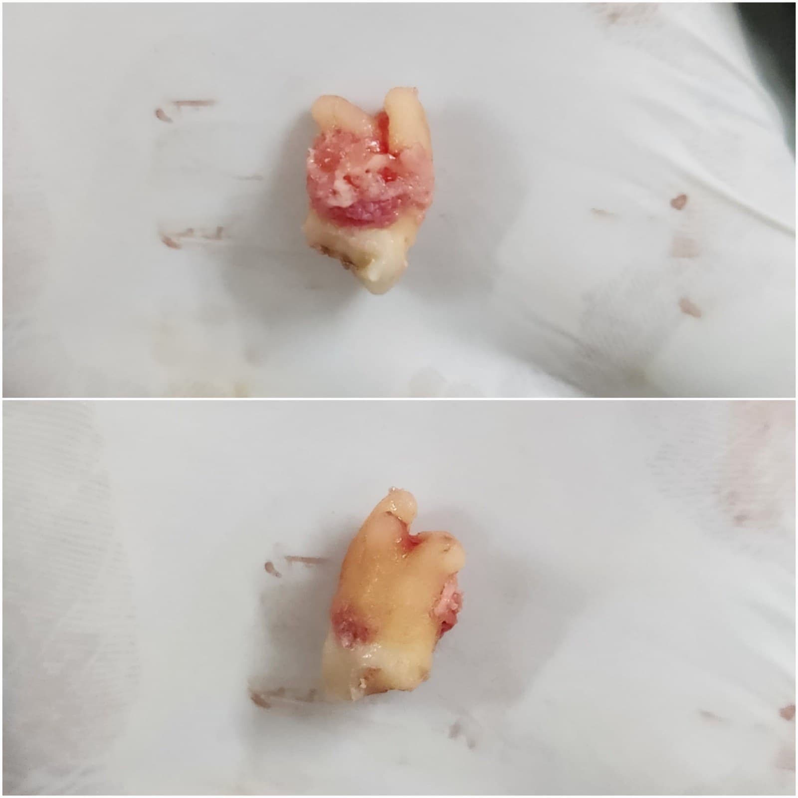 Wisdom tooth removal