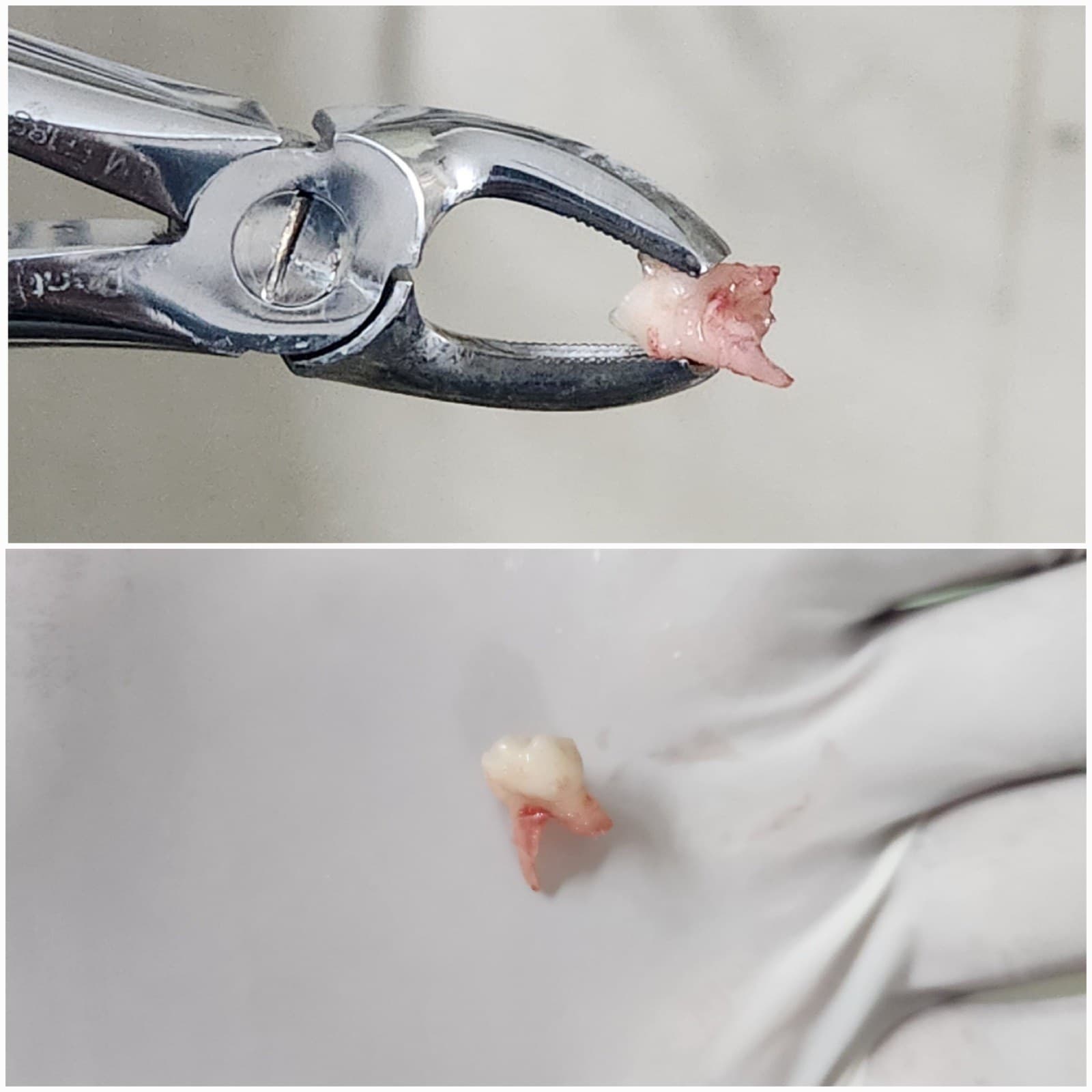 Wisdom tooth removal