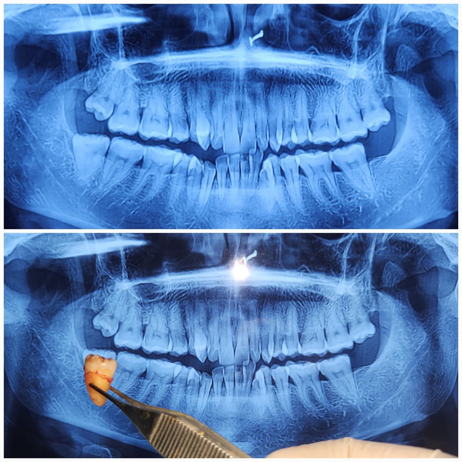 Wisdom tooth removal
