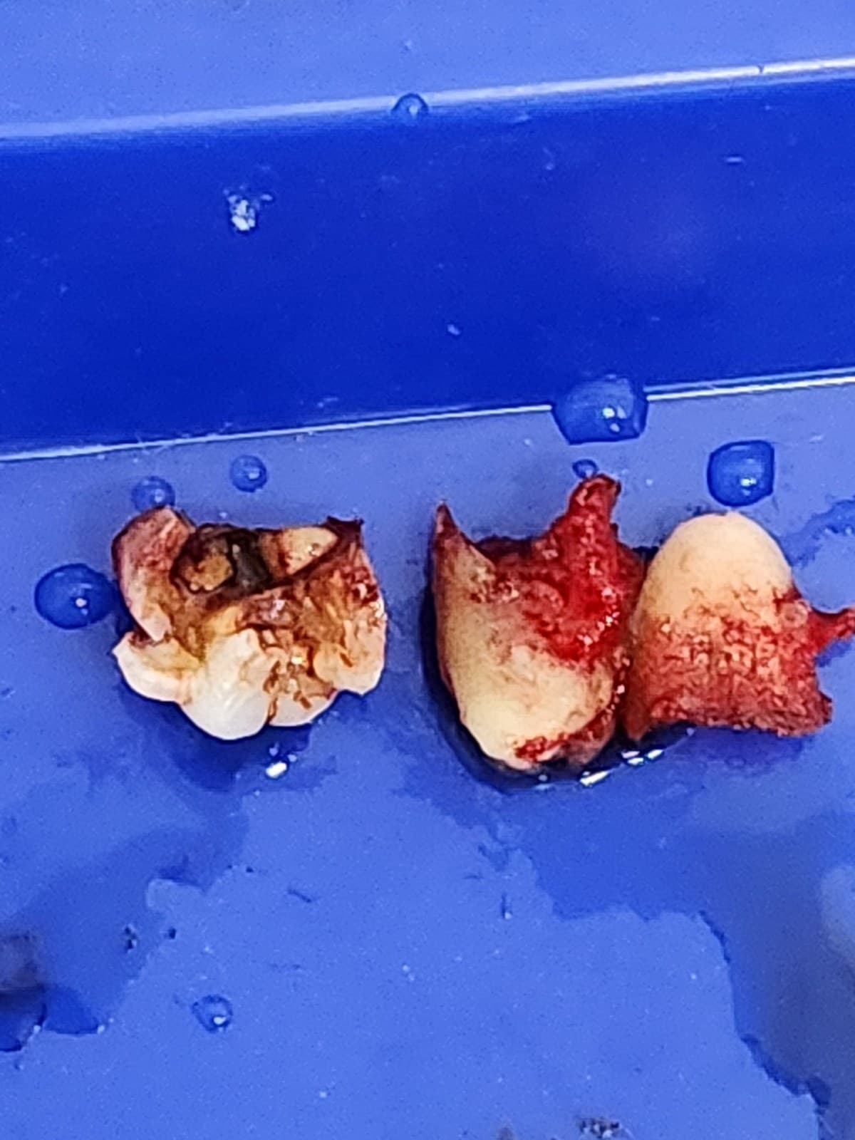Wisdom tooth removal