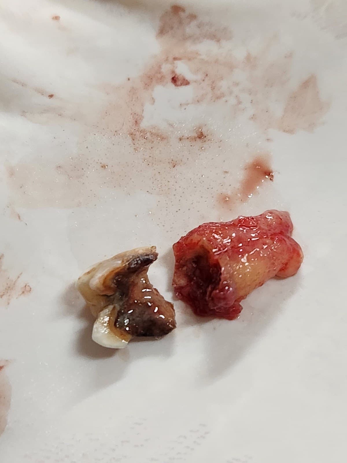 Wisdom tooth removal