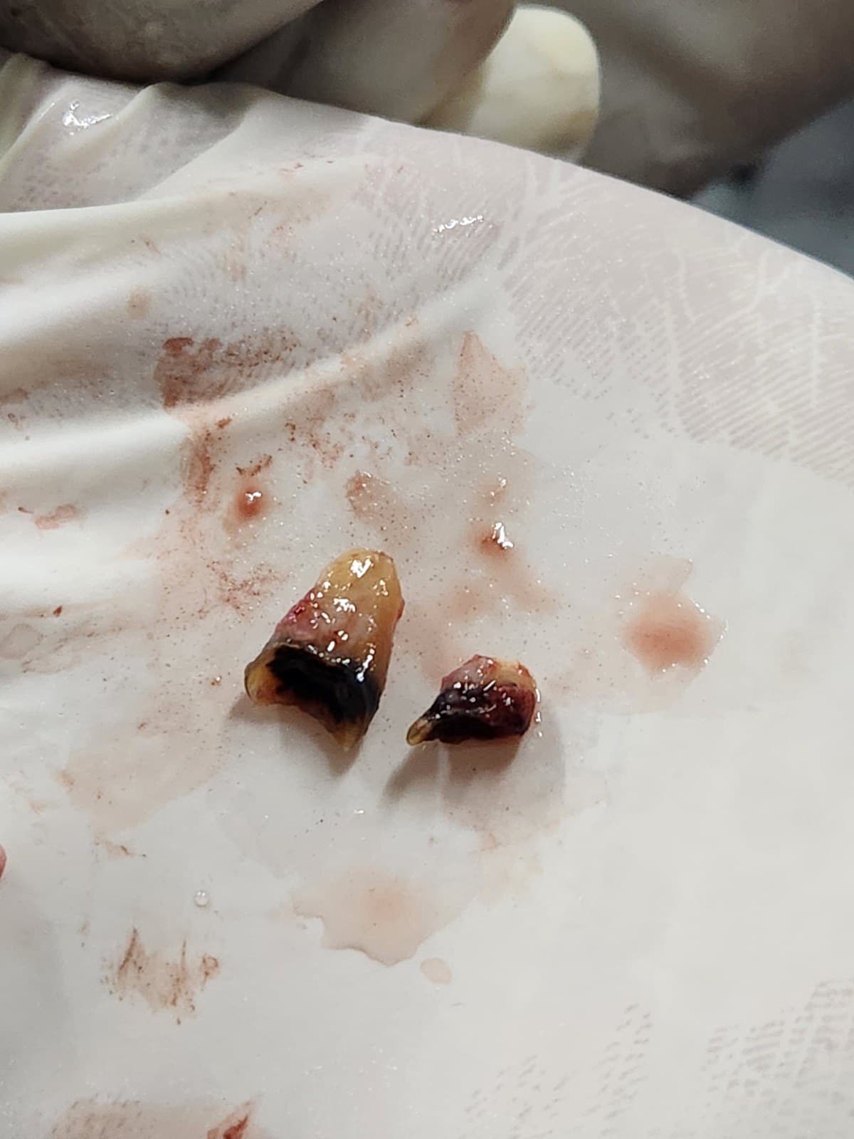 Wisdom tooth removal