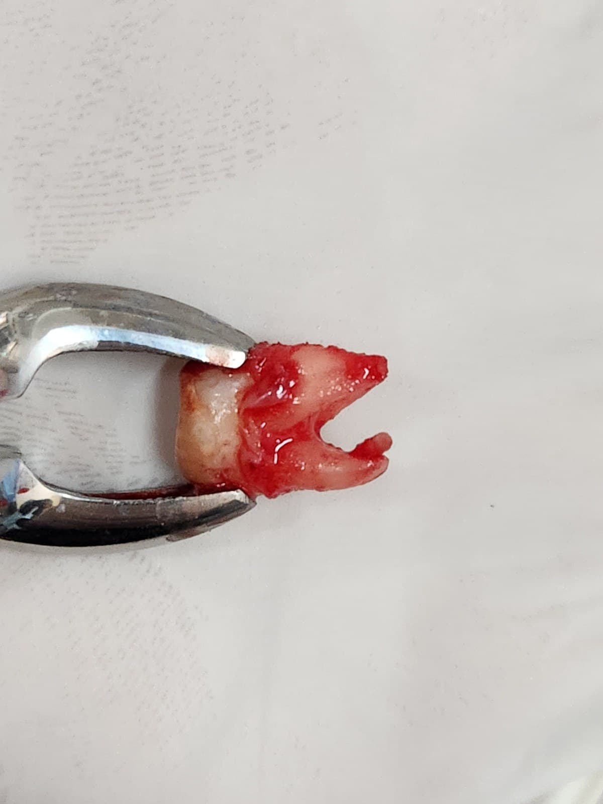 Wisdom tooth removal