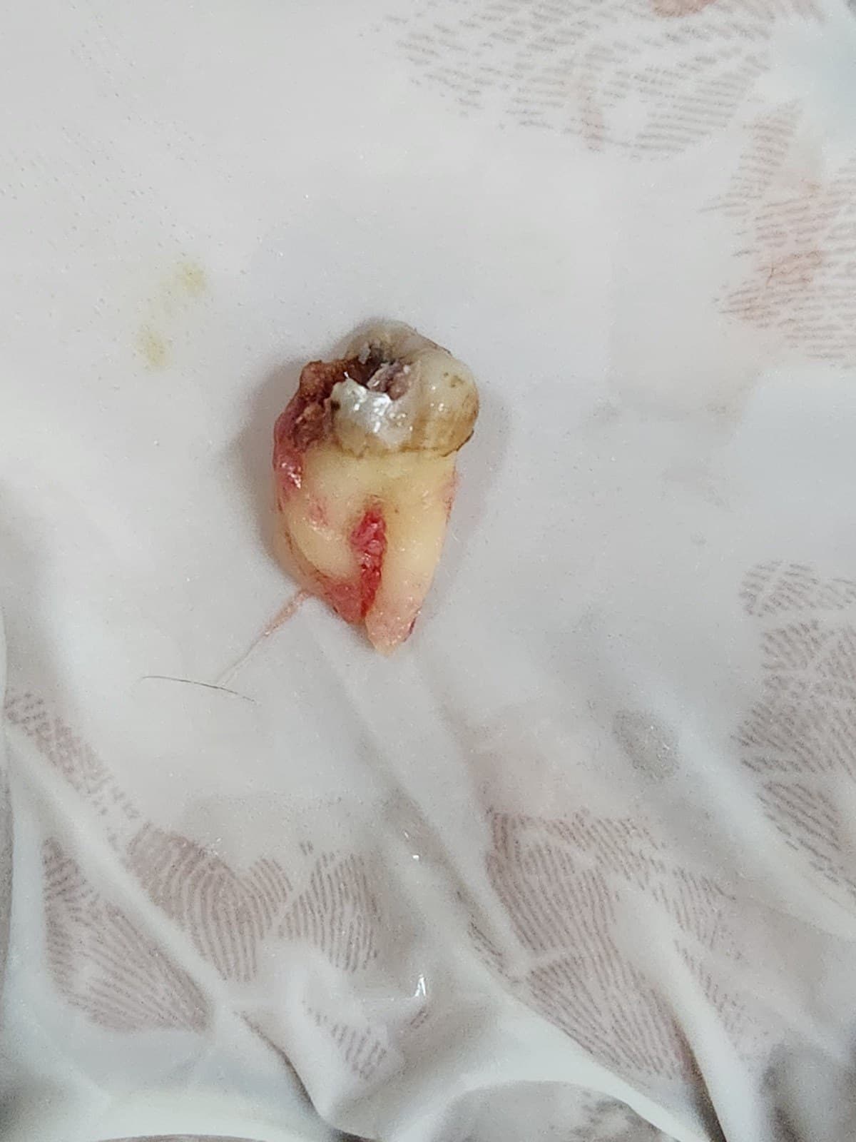 Wisdom tooth removal