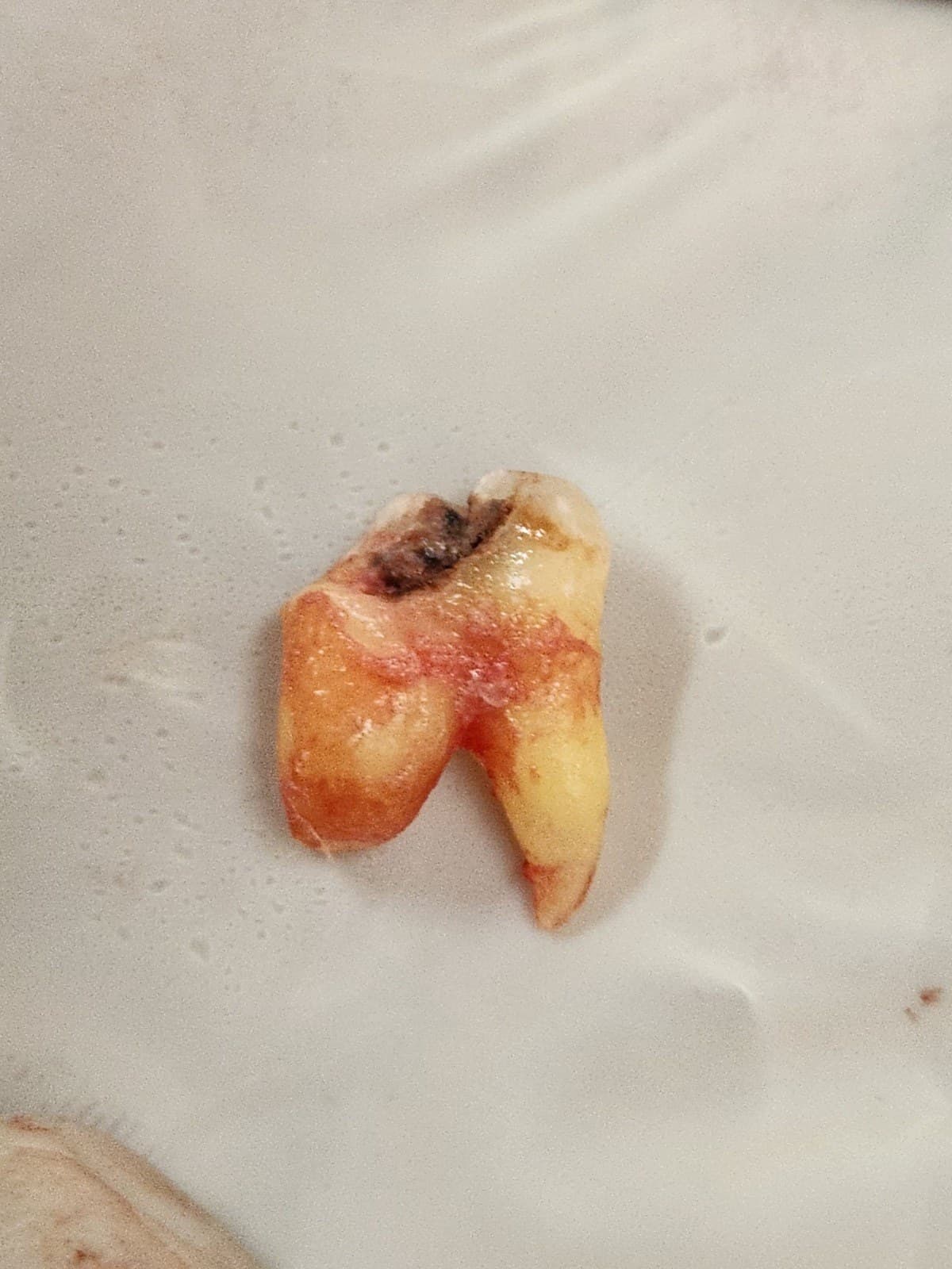 Wisdom tooth removal