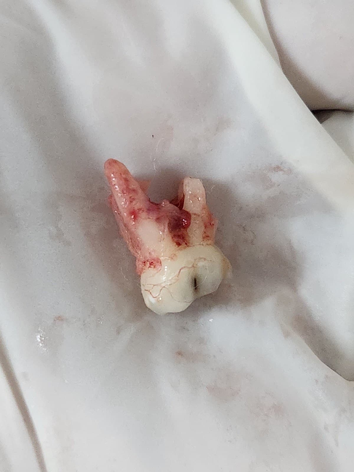 Wisdom tooth removal